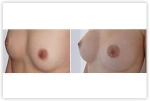 Augmentation par prothèses rondes de 300cc en position rétro-musculaire par cicatrice péri-aréolaire