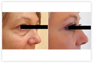 Blépharoplastie superieure et inférieure permettant un rajeunissement naturel du regard: retrait de l'excedent de peau au niveau des paupières supérieures et des poches sous les yeux sans hyper-correction
