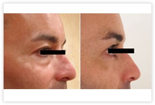 Résultat de blépharoplastie inférieure par voie conjonctivale qui a permis le retrait complet et définitif des poches graisseuses situées sous les yeux