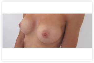 Cicatrice hémi-aréolaire inférieure arrivée à maturité après pose d'implants de 280cc