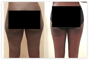 Correction définitive de la culotte de cheval