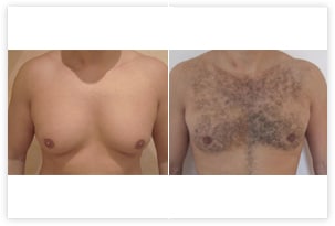 Correction de gynécomastie chez un homme
