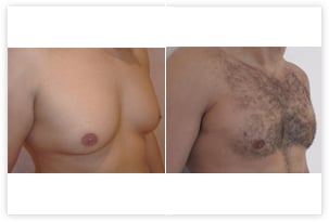Correction de l'hypertrophie de la poitrine chez un homme