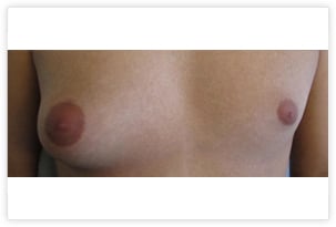 Gynécomastie glandulaire et graisseuse unilatérale droite chez une homme de 24 ans