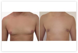 Gynécomastie graisseuse pure traitée par liposuccion chez un homme de 32 ans