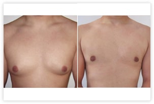 Gynécomastie mixte (glandulaire et graisseuse) chez un homme de 34 ans