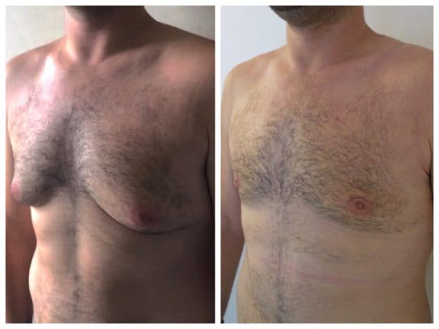 Résultat operation de gynecomastie sans cicatrices transversales