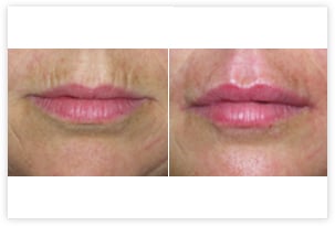 Injections d'acide hyaluronique avant/après (plissés du soleil)