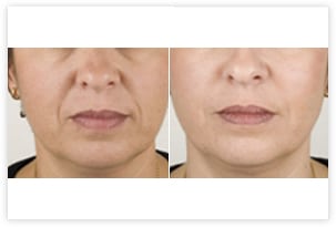 Injections d'acide hyaluronique avant/après (sillons naso-géniens)
