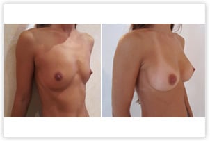 Hypotrophie mammaire corrigée par implants de 280cc