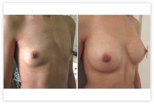 Mise en place d'implants de taille de 260 cc disposés en arrière du muscle pectoral