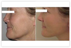 Lifting du visage et du cou avant/après