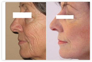 Résultat avant/après d'un lifting du visage cervico-facial traitant l'excédent cutané des joues et du cou