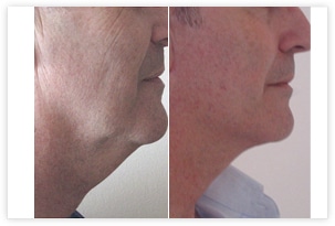 Lifting du visage et du cou chez un homme avant/après