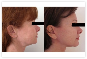Photo avant après lifting du visage chez une femme de 50 ans corrigeant les bajoues et l'excès cutané au niveau du cou