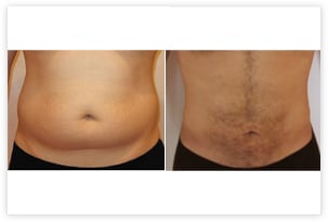 lipoaspiration ventre homme