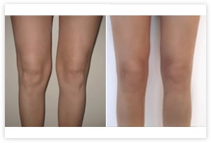 Liposuccion des cuisses et de la culotte cheval avant/après