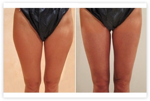 Liposuccion des cuisses