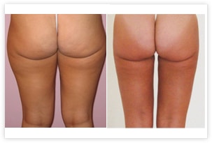 Lipoaspiration circulaire de la culotte de cheval, des cuisses et des genoux