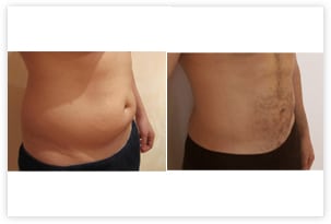 Liposuccion du ventre et des poignées d'amour chez un homme