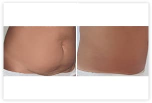 Mini abdominoplastie ou mini-lift abdominal avec liposuccion du ventre
