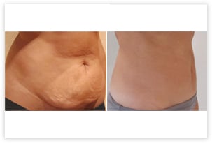 Mini-lifting abdominal (mini-abdominoplastie) avec lipoaspiration du ventre