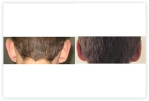 Chirurgie esthétique des oreilles décollées avant/après
