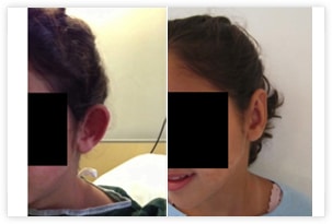 Opération d'otoplastie corrigeant le décollement