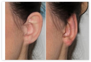 Chirurgie esthétique des oreilles décollées avant/après