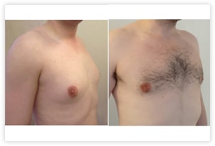 Photo de gynecomastie glandulaire et graisseuse traitée