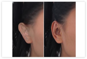 Photo d'otoplastie avant après