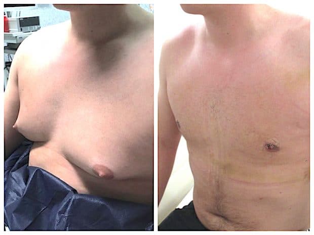 Premier pansement après une operation pour gynecomastie mixte bilaterale