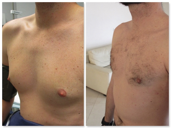 Reduction chirurgicale d'une gynécomastie mixte bilatérale chez un homme 