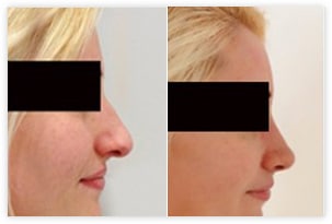 Rhinoplastie ou chirurgie esthetique du nez