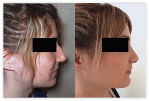 La rhinoplastie a permis de traiter la trop grande projection du nez
