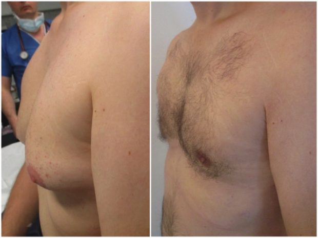 traitement chirurgical de gynecomastie avec adipomastie à cicatrice supérieure