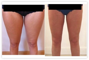 traitement cuisses genoux
