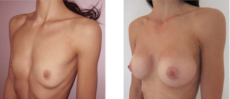 Augmentation par prothèses pour correction d'hypotrophie mammaire sévère