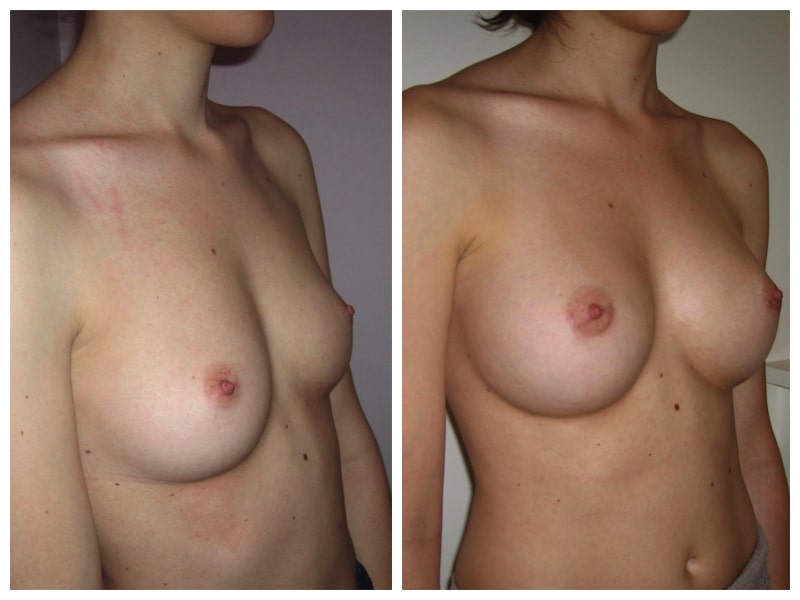 Augmentation de la poitrine par implants de 300cc en Dual Plan
