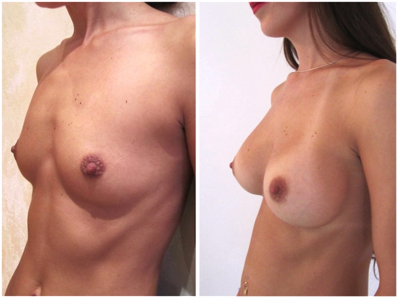 Augmentation mammaire avec implants de 280cc