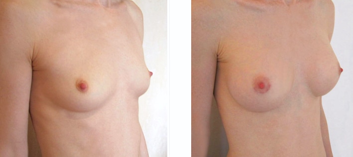 Augmentation mammaire par prothèses rondes de 240 cc (cicatrice hémiaréolaire inférieure)
