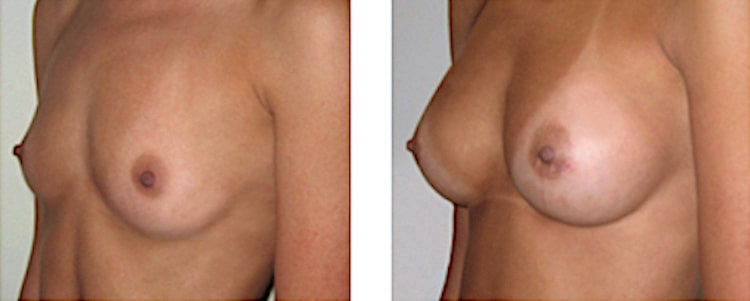 augmentation mammaire par prothèses de 300cc