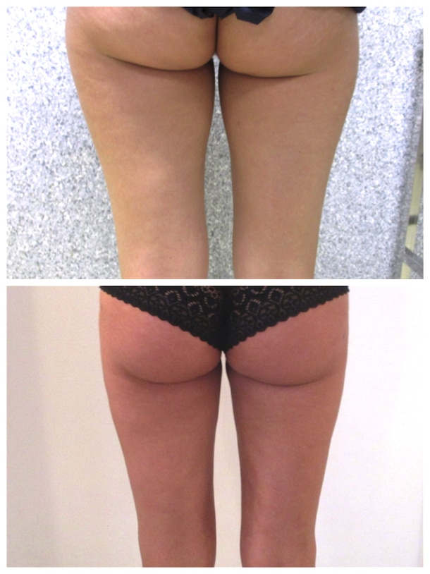 Traitement de la culotte de cheval et de la face internes des cuisses
