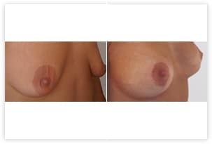Prothèse mammaire avec plastie pour correction d'hypotrophie avec ptose