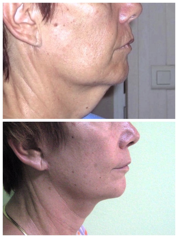 Résultat naturel d'un lifting de l'ovale du bas du visage