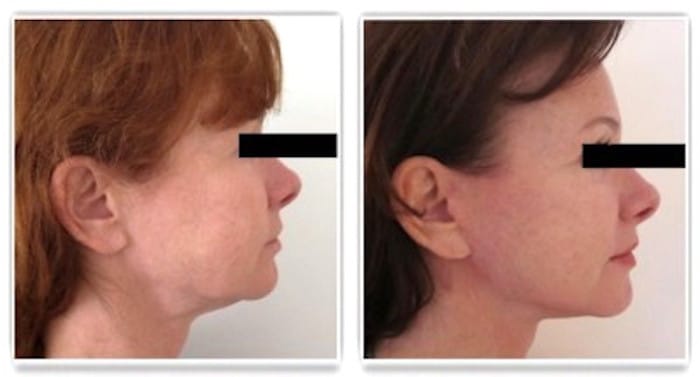 Résultat d'un lifting cervico-facial