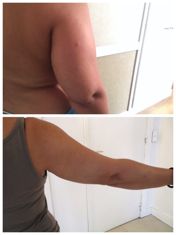 lipoaspiration des bras