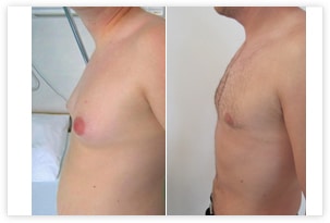 correction exces graisseux ventre poitrine