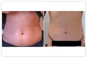 Résultat de liposuccion du ventre et de la taille chez une femme