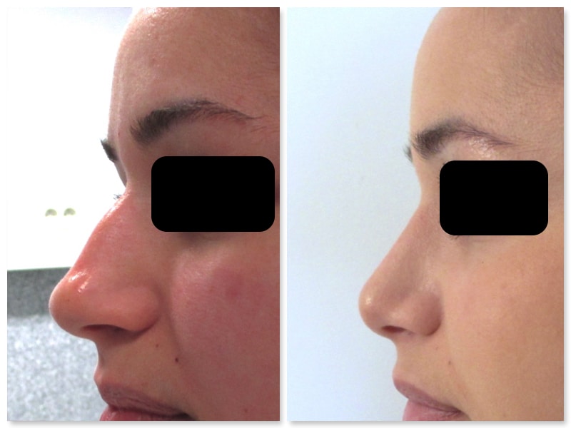 resultat-rhinoplastie-traitant-projection-bosse